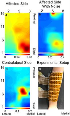 Estimation of Muscle Force Based on Neural Drive in a Hemispheric Stroke Survivor